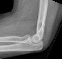 Fat pad sign in non-displaced radial head fracture (Wiki)